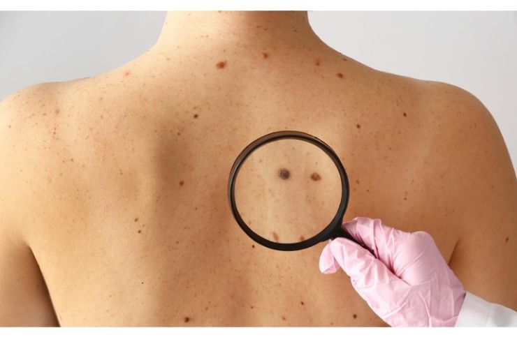 Melanoma, cosa è