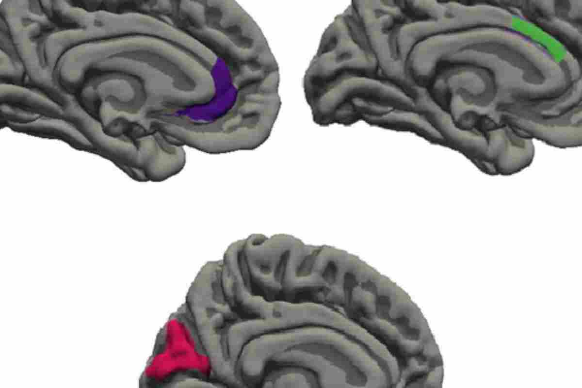 L'emicrania lascia impronte nel cervello e nell'intestino dei bambini, lo studio 