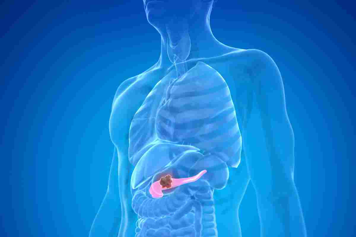 Tumore al pancreas, potenziali effetti benefici da un farmaco anti-asmatico